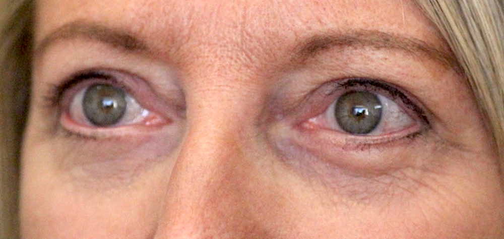 after upper and lower blepharoplasty picture