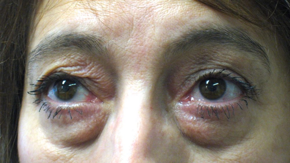 Before Upper & Lower Blepharoplasty