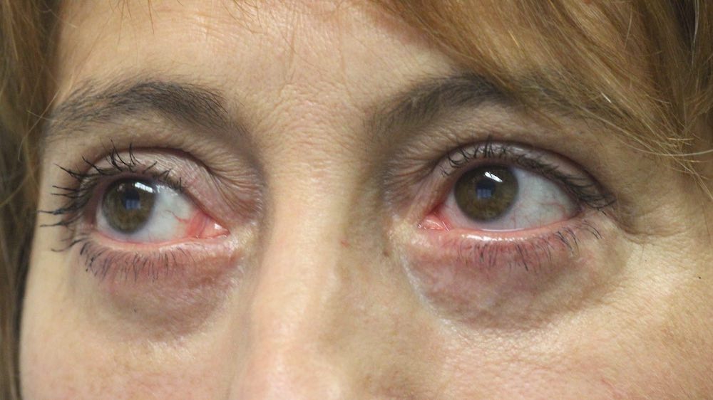 After Upper & Lower Blepharoplasty