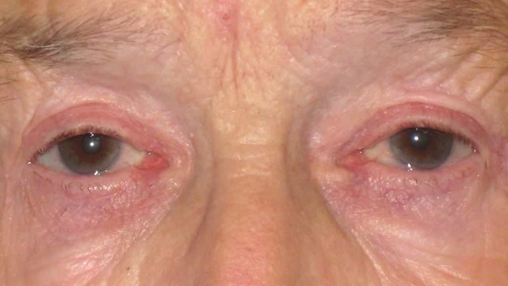 after upper eyelid blepharoplasty pictures 1