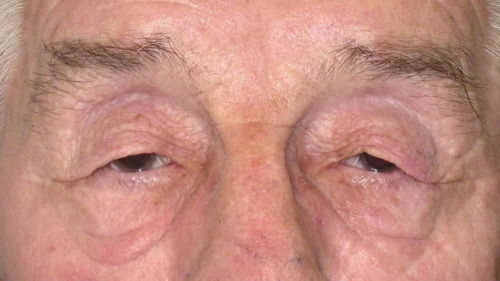 before upper blepharoplasty 2