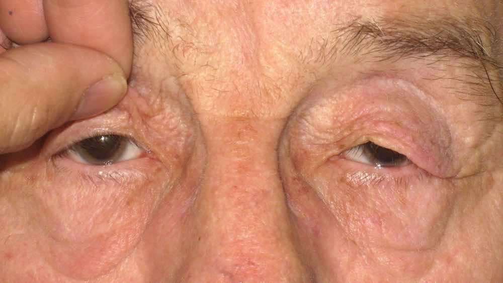 before upper bleppharoplasty ptosis surgery 2