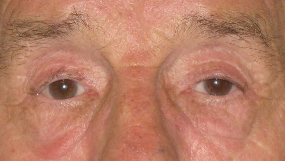 after ptosis blepharoplasty 2