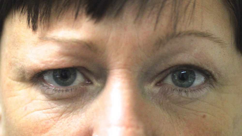 before upper lid lift