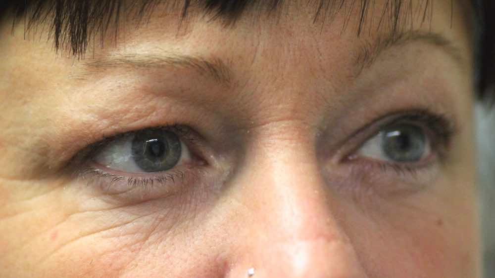 before upper lid lift