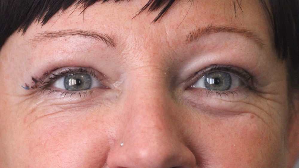 after upper lid lift