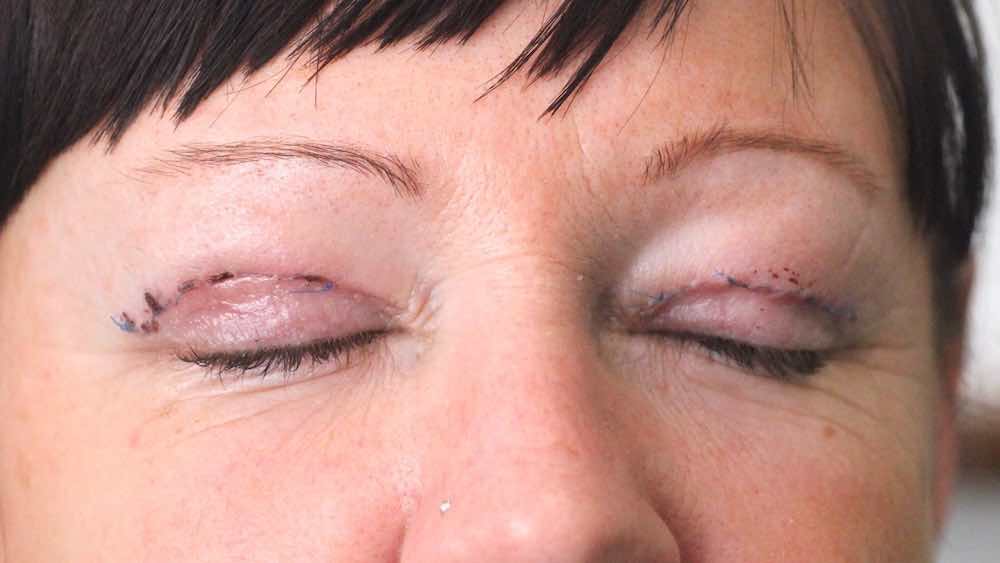 after upper lid lift endotine transblepharoplasty brow lifting