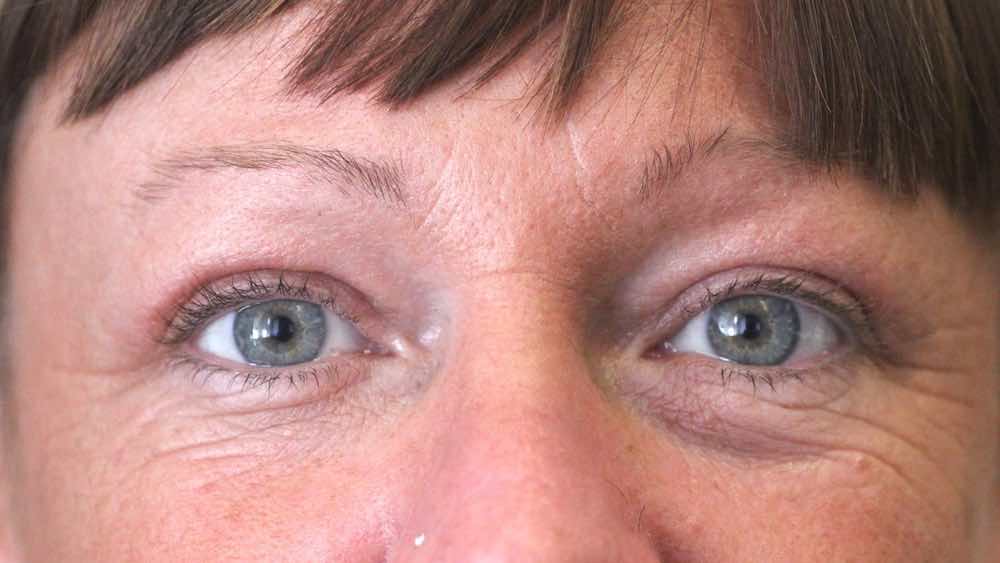 3 months after upper lid lift endotine lift