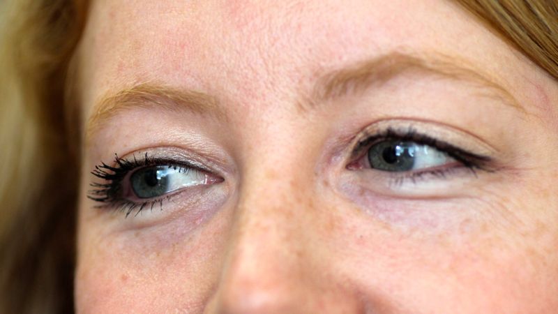 2 weeks after injection of Restylane in to the tear trough. Notice the increased fullness to the tear trough. The filler helps camouflage the bulge of the lower lid caused by prolapsing fat pads. One can see why this procedure is sometimes termed a â€˜non-surgical blepharoplastyâ€™