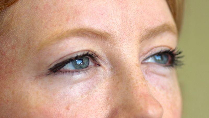 2 weeks after injection of Restylane in to the tear trough. Notice the increased fullness to the tear trough. The filler helps camouflage the bulge of the lower lid caused by prolapsing fat pads. One can see why this procedure is sometimes termed a â€˜non-surgical blepharoplastyâ€™