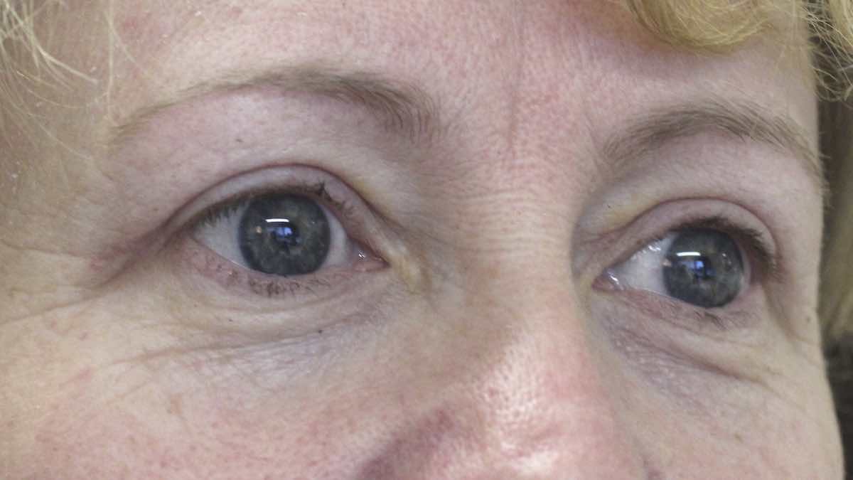 after internal browpexy and blepharoplasty left 4