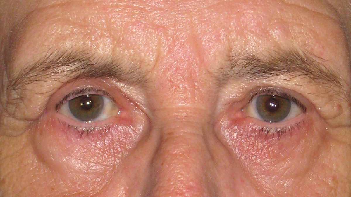 after transblepharoplasty endotine brow lifting