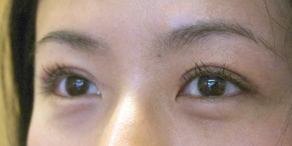 Double Eyelid Surgery