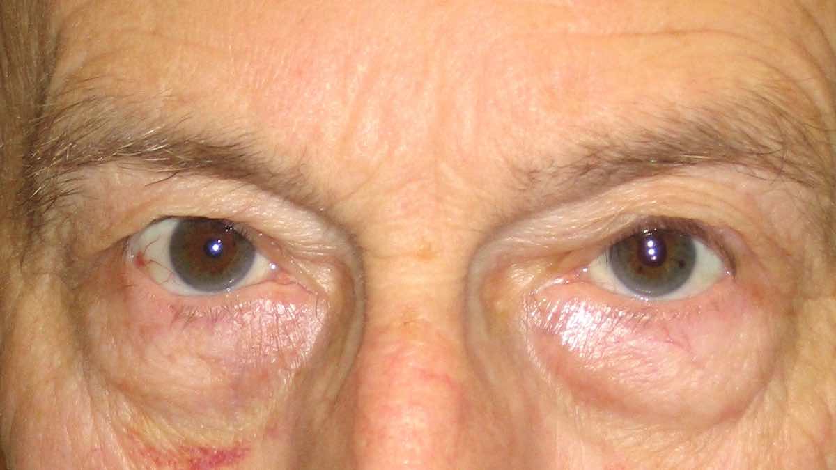 eyelids after ptosis correction surgery