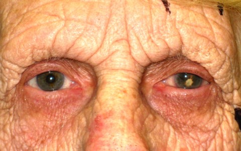 Before removal: the left eye of this lady is blind, painful and shrunken. Note how much smaller it looks. 