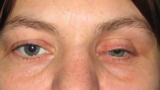 Post Enucleation Socket Syndrome: Before treatment with filler injections. Note how sunken the left (her left) artificial eye has become through many years of wearing an artificial eye. 