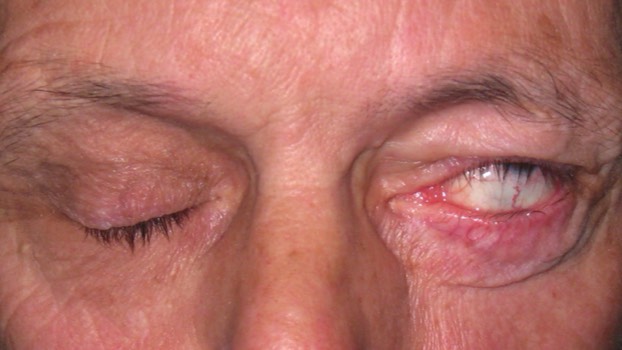 Facial Nerve Palsy: This patient cannot close his left eye
