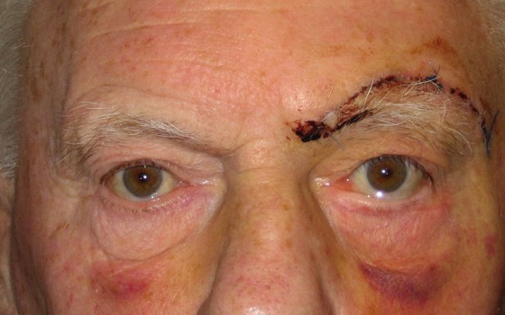1 week following surgery. Note the symmetry of the eyebrows