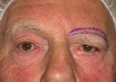 Direct Brow Lifting: Preoperative marking of the amount of skin removal required to lift up the droopy eyelid