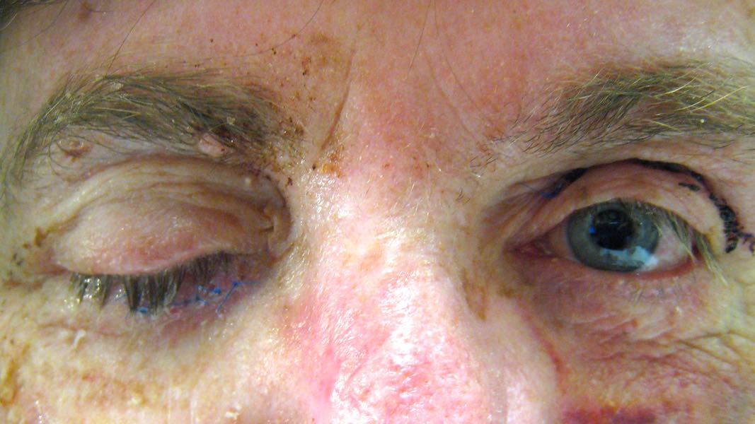 The Hughes flap is allowed to heal for 2 weeks meaning the patient cannot open her affected eye. 