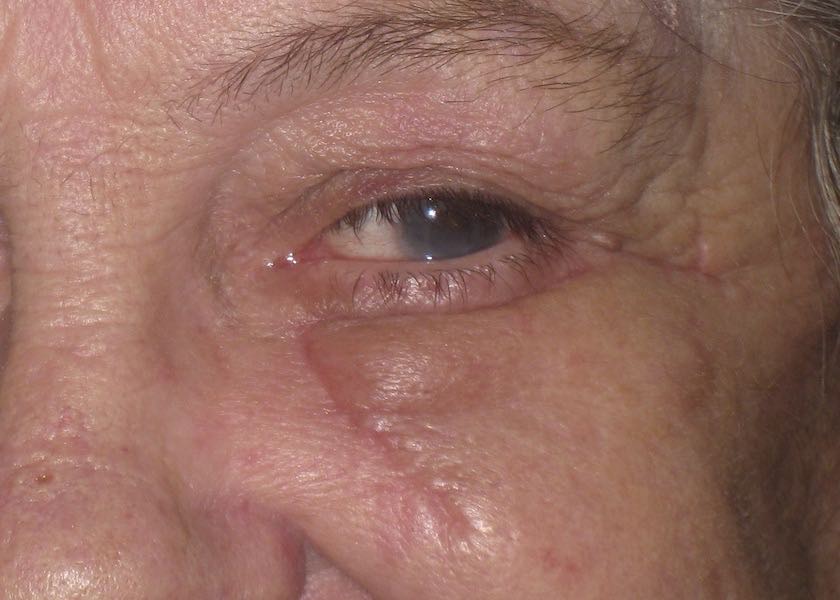 2 weeks following reconstruction with skin flap. Notice the flap is still thickened. The patient is asked to massage the flap with antiscarring silicone gel for 3 months following surgery.  