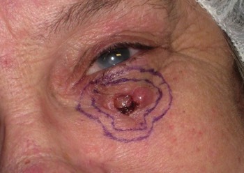 The skin cancer has been marked ready for surgical removal. Note cancer is removed with a rim of normal skin to ensure complete removal of the skin cancer. 