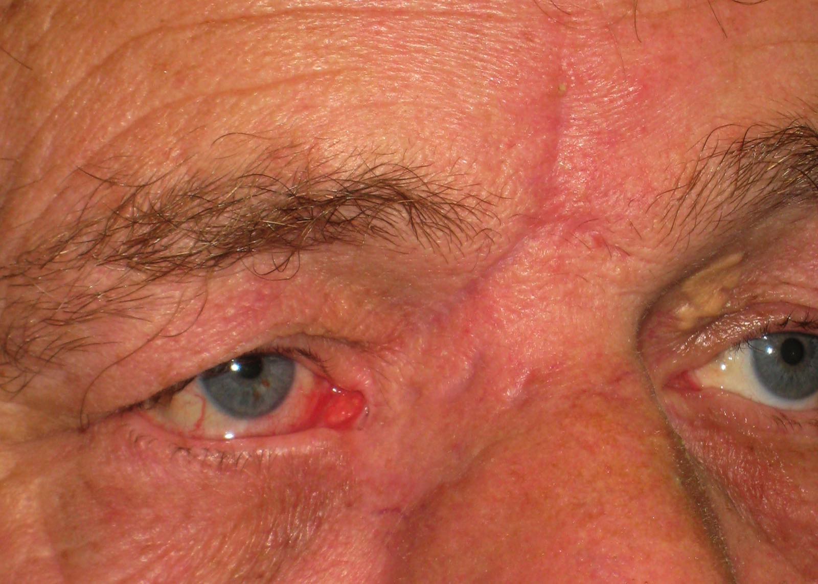 Eyelid Skin Cancers Eyelid Bcc Mr David Cheung Eyelid Specialist Birmingham Uk