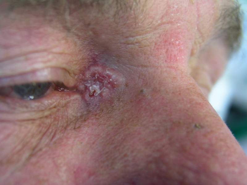 Very poorly defined mixed infiltrative nodular BCC. These lesions are particularly dangerous with a propensity to invade into the eye socket