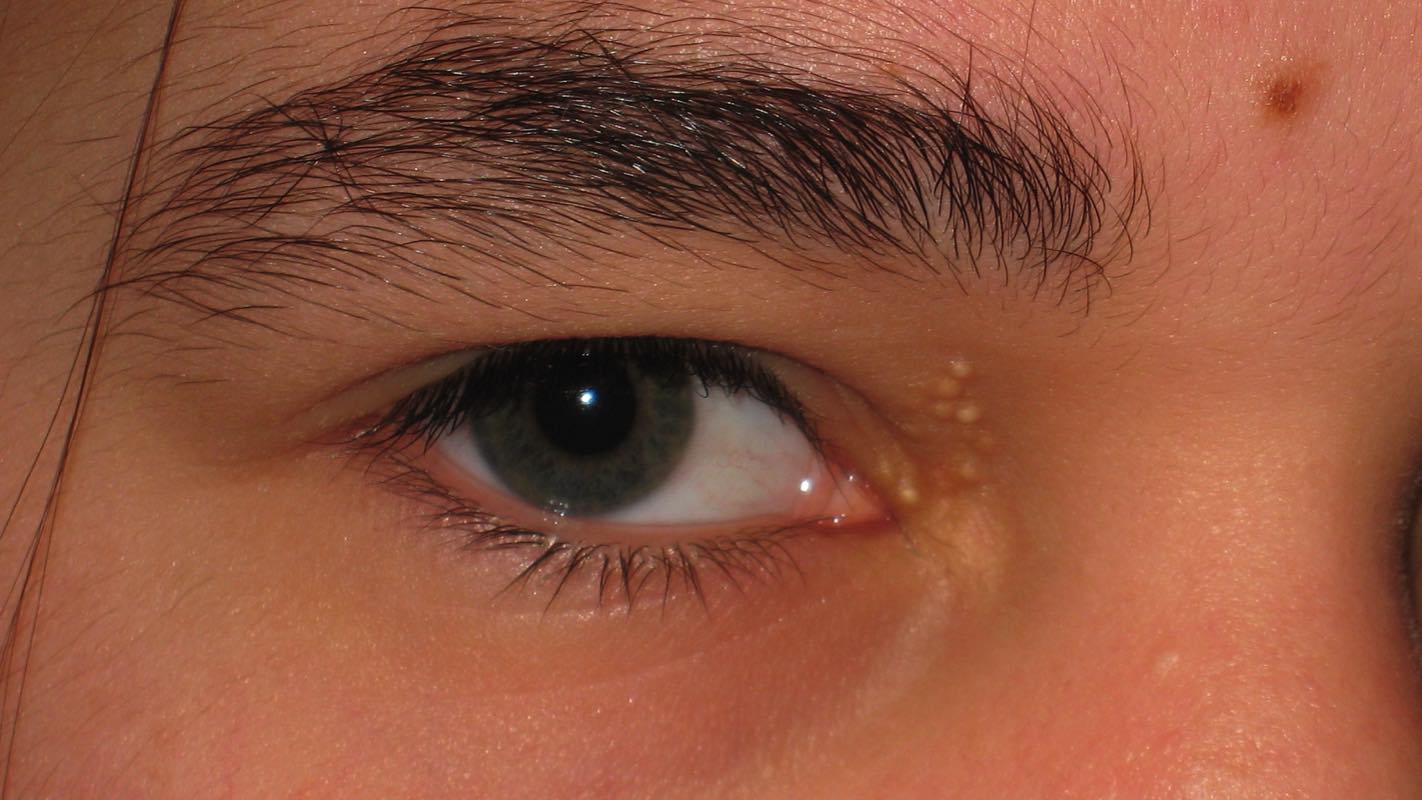 skin tags on eyelids