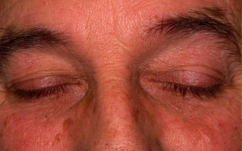 2 weeks following surgery: Unlike xanthelasma, sebaceous cyst surgery is less complex and less risky. 