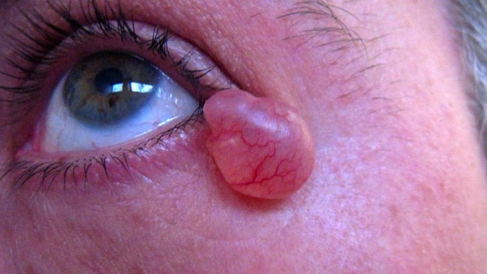 Some benign cysts enlarge to become a functional and cosmetic problem