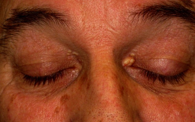 Sebaceous of the eyelids: These are sometimes confused for xanthelasma/ cholesterol patches