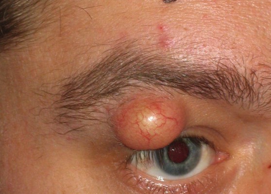 Some sebaceous cysts can grow quite large. Careful removal is necessary to avoid scarring and collateral damage to local muscles and nerves