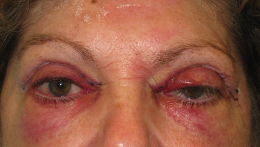 Rehabilitation surgery: Immediately following left upper eyelid lowering and blepharoplasty surgery to all 4 eyelids