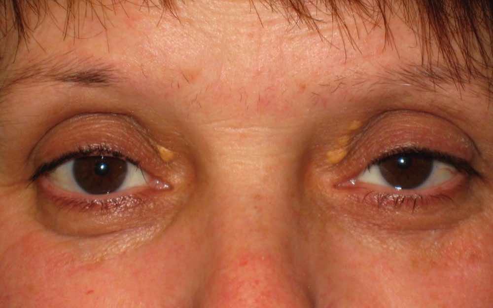 cholesterol bumps on eyelids