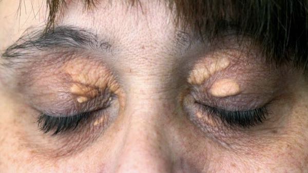 surgery for xanthelasma cholesterol patches around eyes